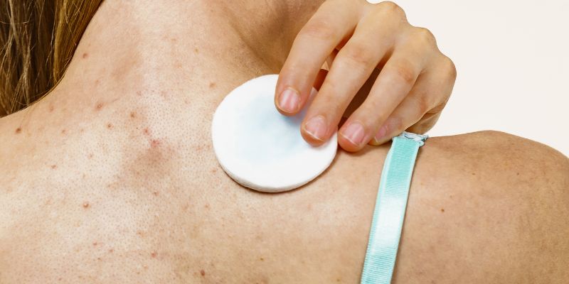 Can Vicks Help Treat Acne? 